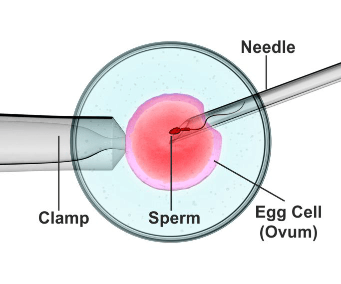 Cataract